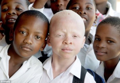 Albinismo