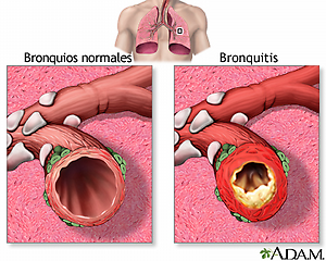 Bronquitis